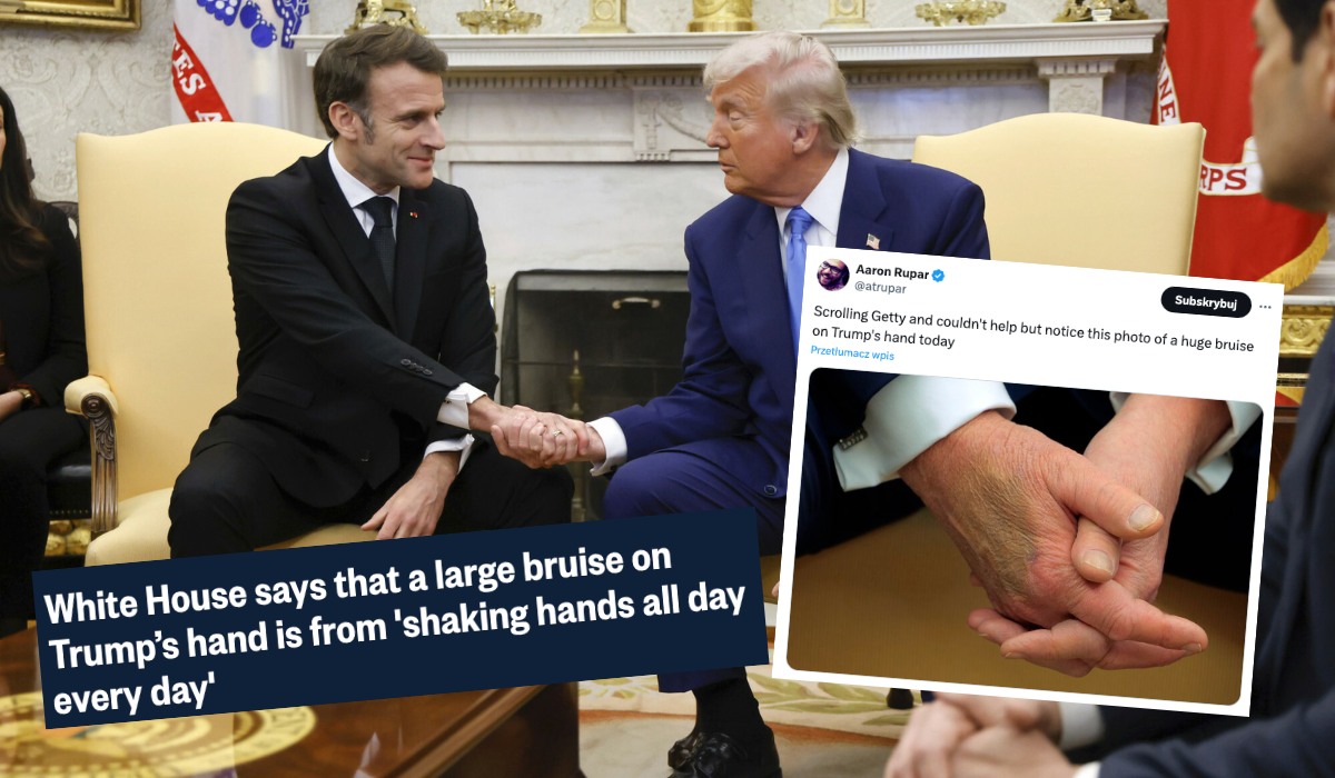 Trump dorobił się dorodnego siniaka od swojego słynnego potężnego uścisku dłoni