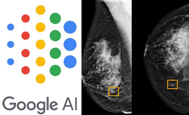 Sztuczna inteligencja Google wykrywa raka piersi lepiej niż lekarze