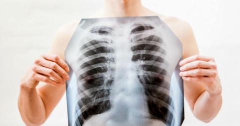 Fatalne wyniki badania płuc w Rybniku. 50% mieszkańców z zaburzeniami układu oddechowego