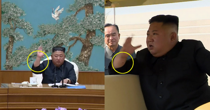 NK News: ślad na ręku Kim Dzong Una może być efektem zabiegu kardiologicznego