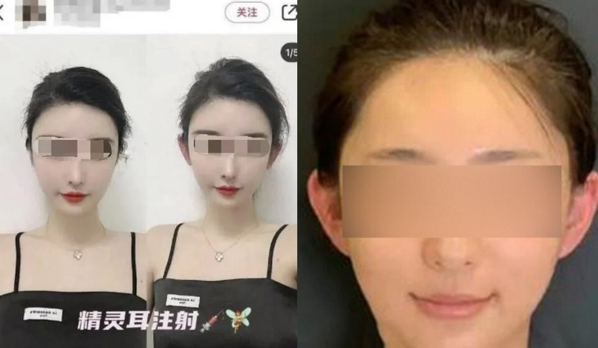 W Chinach zapanowała moda na operacje plastyczne "elfie uszy"