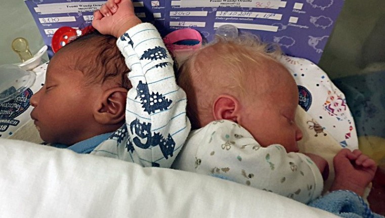 W szpitalu w Łodzi urodziły się bliźnięta o różnych kolorach skóry