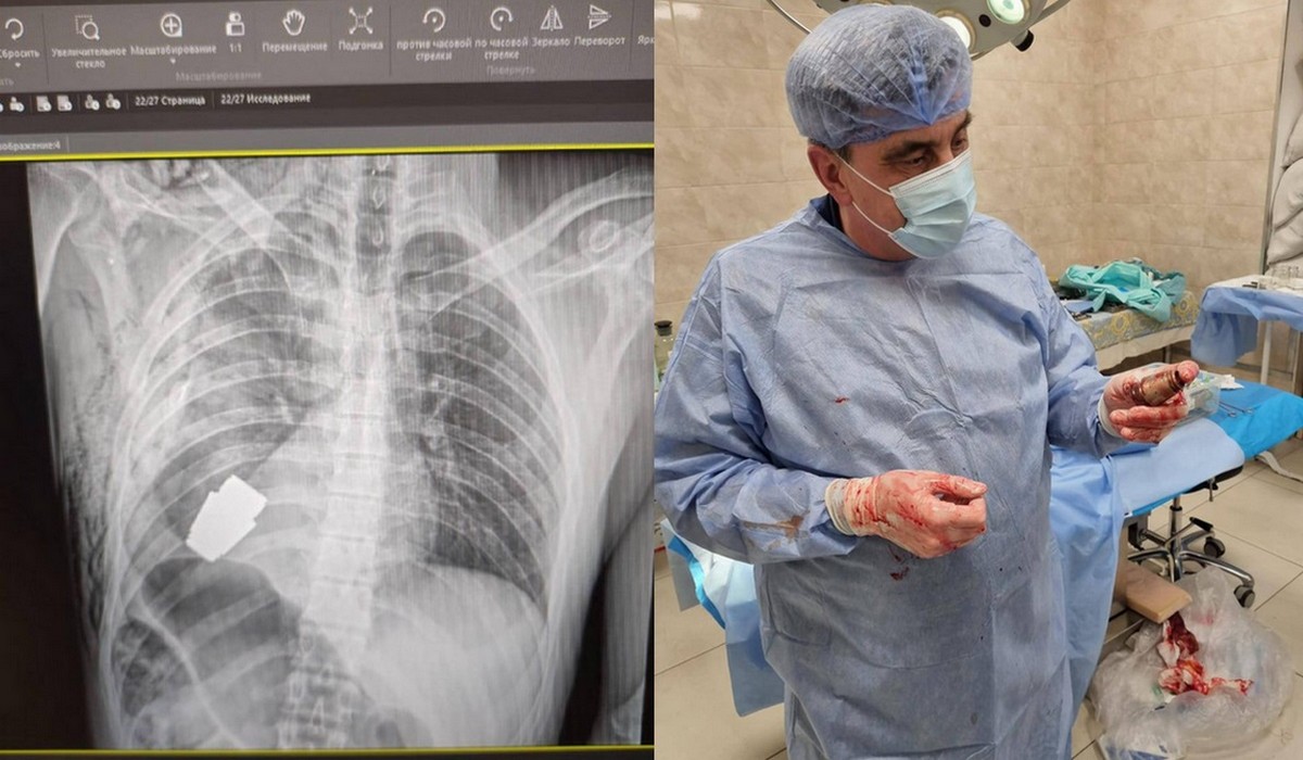 Ukraina: lekarze przeprowadzili operację i wyciągnęli niewybuch z ciała żywego żołnierza